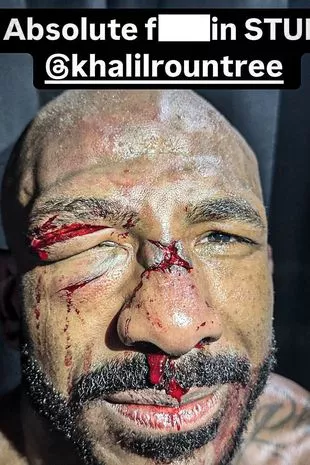 UFC明星在残酷的失败后被毁容,一只眼睛闭上了