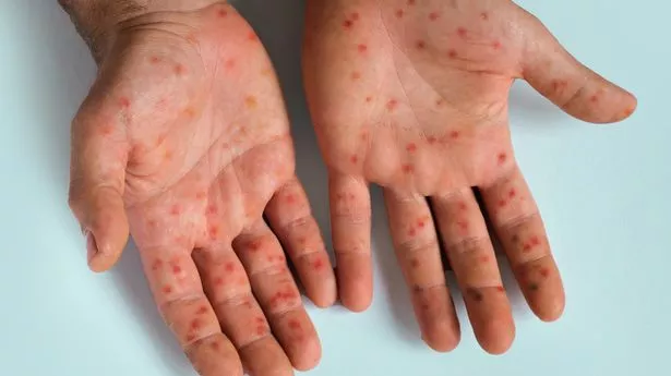Mpox:专家如此担心女性感染病毒的可怕原因