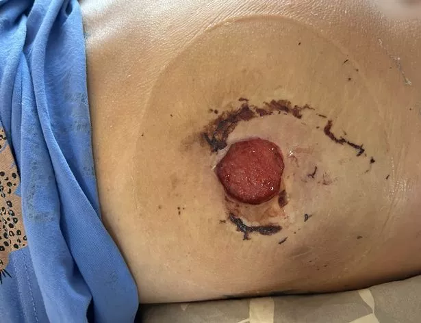 “我的速效液体BBL开始腐烂——疼痛比分娩还严重。”