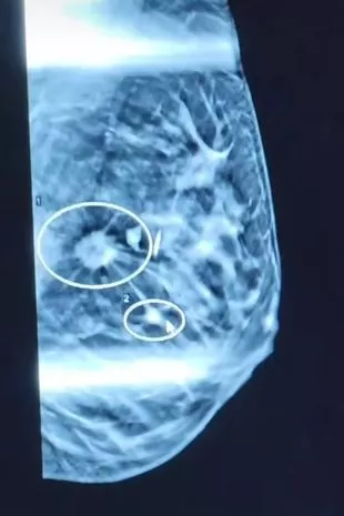 当我发现肿块时，医生说我“反应过度”，然后我得到了一个毁灭性的消息