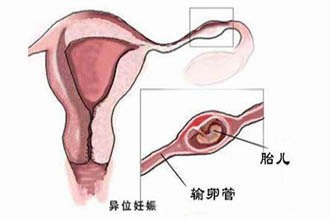 颖儿健康风波，从腹部剧痛到勇敢抉择—记一次胆囊切除手术的心路历程